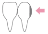 義歯治療 イメージ